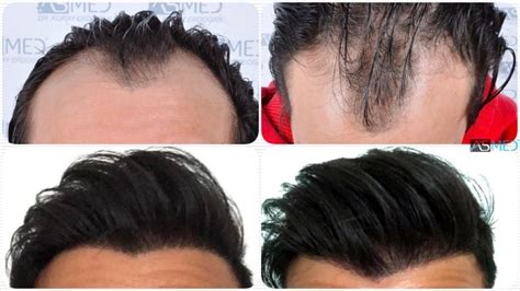 Norwood 3 Hair Transplantation Results | Asmed Hair Transplant