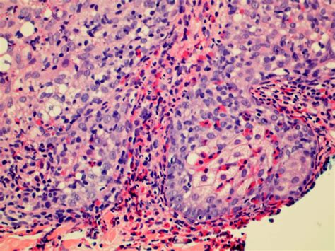 Eosinophilic Pustular Folliculitis Histology