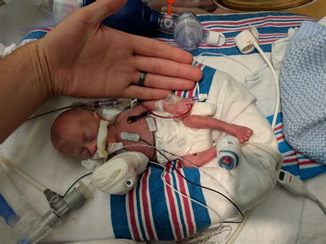 ‘Miracle Baby’: One of the smallest premature infants ever heads home