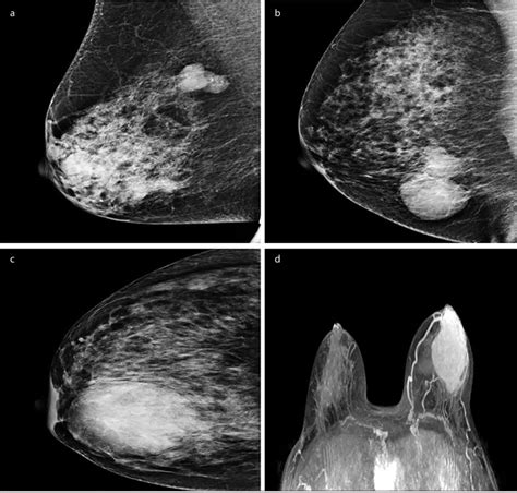 a-d. Benign phyllodes tumor mammography imaging (a). Borderline... | Download Scientific Diagram