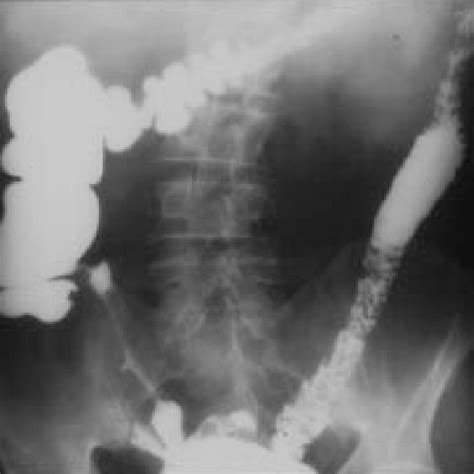 Endoscopic appearance of normal terminal ileum. | Download Scientific Diagram