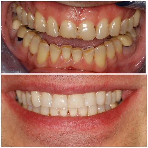 Dental Veneers - DrBK Cosmetic Dentist & Aesthetics Clinic in Reading, Berkshire