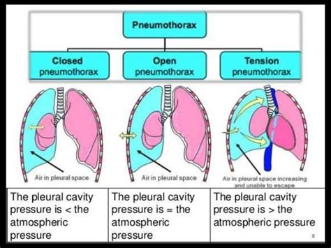 Loculated Pleural Effusion Meaning - VATS for Loculated Pleural Effusion - Dr. Amol Bhanushali ...