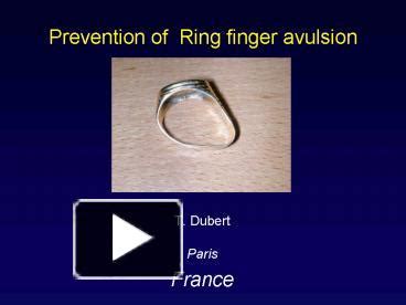 PPT – Prevention of Ring finger avulsion PowerPoint presentation | free to view - id: 21d846-NmFkN