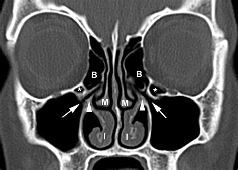 Sinus CT Scan Report | Paranasal Sinuses, Sinusitis, CT Scan