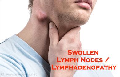 Swollen Lymph Nodes | Lymphadenopathy - Causes, Symptoms, Diagnosis, Treatment