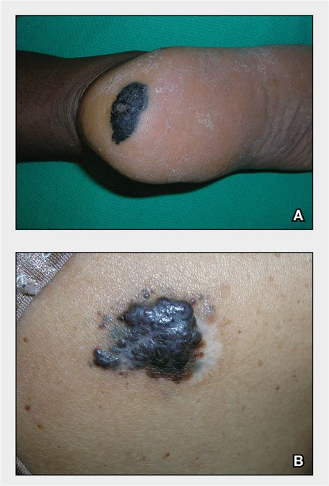 Acral Lentiginous Melanoma Metastatic Melanoma