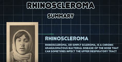 Scleroma of the nose: causes, pathology, symptoms, treatment