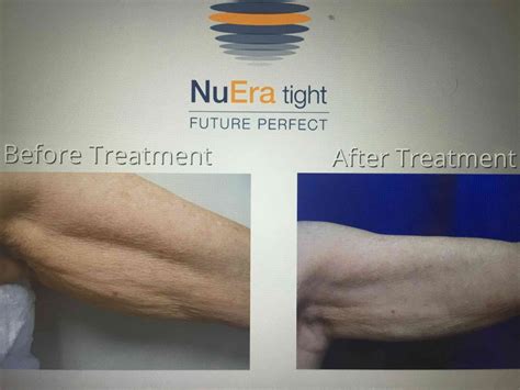 Lumenis NuEra skin tightening arm before and after | Azani Medical Spa