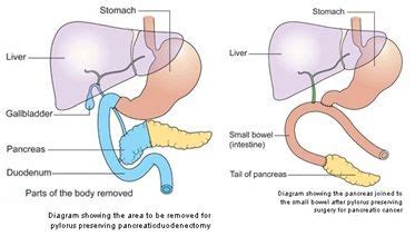 Whipple Surgery for Pancreatic Cancer - Whipple Operation on Diabetes ...