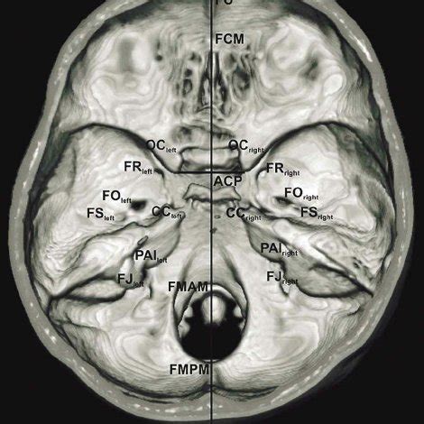 The distance between the tuberculum sellae and dorsum sellae (TS–DS ...