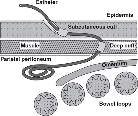 Peritoneal Dialysis Catheters, Placement, and Care | Abdominal Key