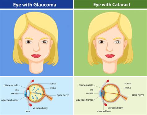 Cataract - Types, Surgery and Prevention