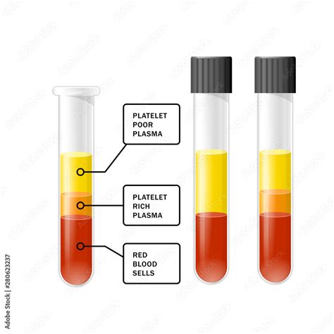 Blood after separation of platelets in the centrifuge in test tube, PRP infographics, platelet ...