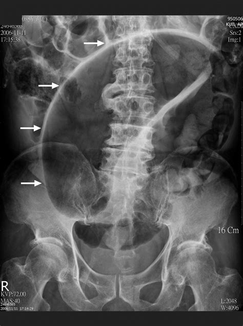 Sigmoid Volvulus Coffee Bean Sign