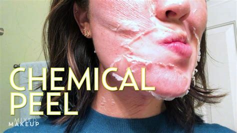 We Tried the Perfect Derma Chemical Peel! | The SASS with Susan and Sharzad | Chemical peel ...