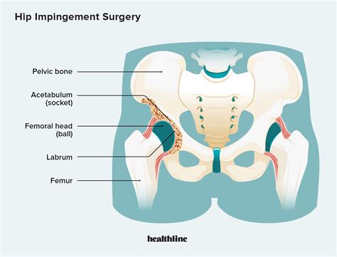 What is Hip Impingement Surgery?