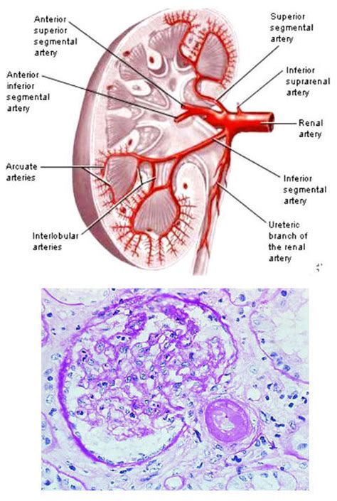 Hypertensive nephrosclerosis