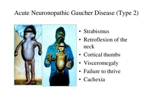 Gaucher disease Symptoms and Treatment | Mediologiest