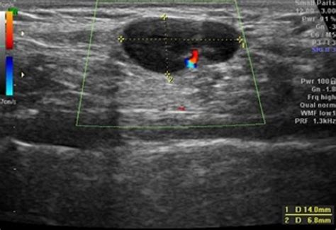 Swollen Lymph Nodes In Neck Ultrasound