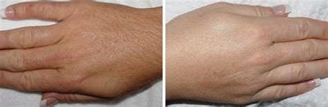 Laser Hair Removal Photos | Houston, Tx | Patient 8036