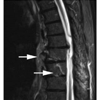 (PDF) Hemoptysis as the Presenting Clinical Sign of a T8-T9 Spine Fracture with Diffuse ...