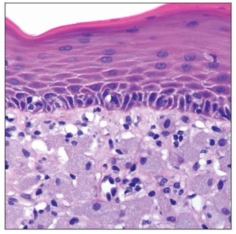 Congenital Epulis of the Newborn | Basicmedical Key