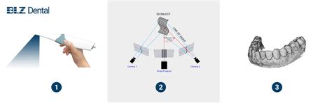 What is an intraoral scanner? - BLZ Dental | Dental Scanner