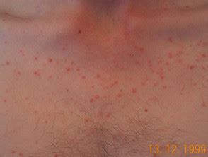 Malassezia (pityrosporum) folliculitis | DermNet