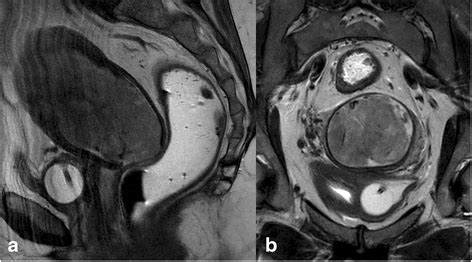 MRI of endometrium cancer – how we do it | Cancer Imaging | Full Text