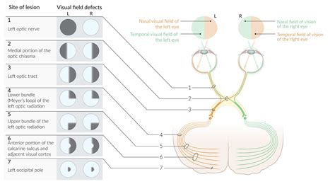 Neurological Visual Field Defect