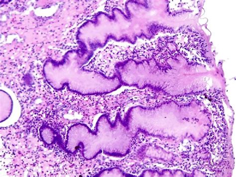 -Severe atrophic chronic gastritis. HE staining, ×100. | Download ...