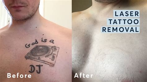 Top 77+ laser tattoo removal before and after latest - in.cdgdbentre