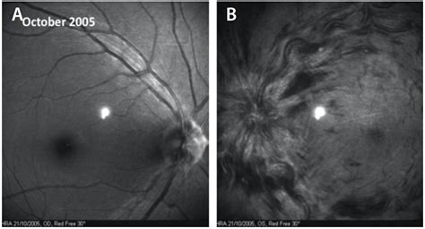 Retina Today - Papillophlebitis: a Closer Look (July/August 2017)