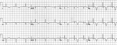 Wellens Syndrome • LITFL • ECG Library Eponym