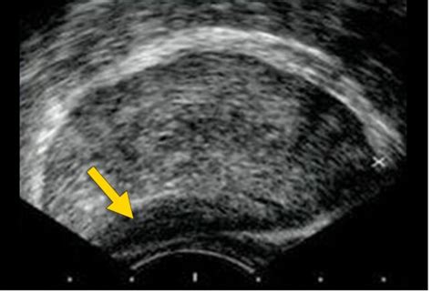 Advanced Prostate Cancer: Signs of Metastatic Disease