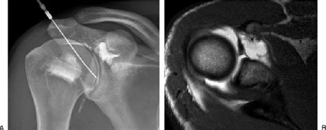 Anterior approach to shoulder arthrogram performed with the patient in... | Download Scientific ...