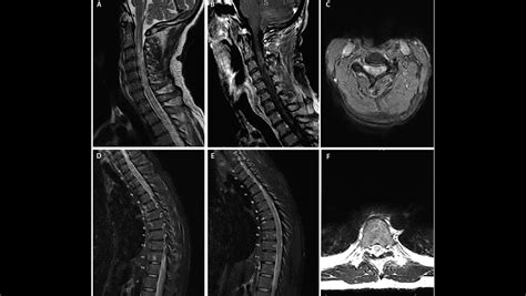 Spinal Cord Lesions - The Neurology Hub