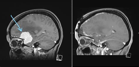 Meningioma – Ashwin Kamath, MD