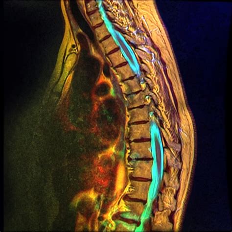 Nevit's blog: Dorsal Spine Color MRI