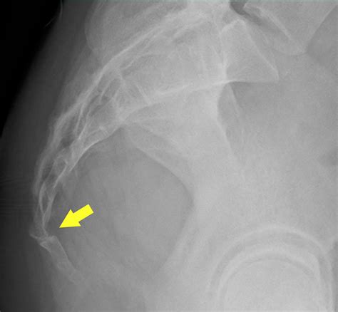 Coccyx subluxation: Coccyx pain aggravated by the prone position - Kumagai - 2022 - Journal of ...