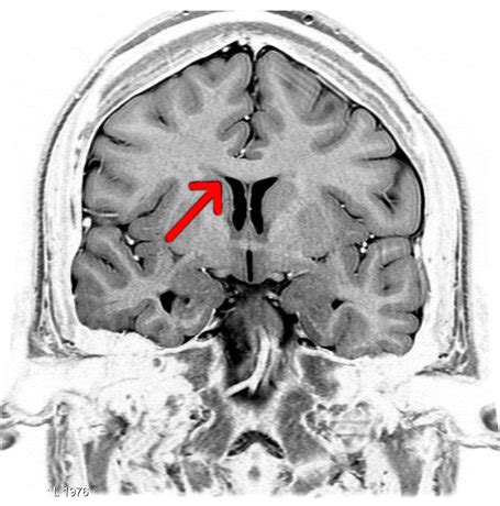 Telencephalon – Language Centers, Limbic System & Basal Ganglia