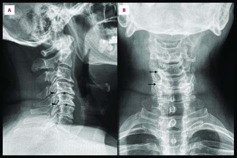 Normal Cervical Spine Radiographs Image Radiopaediaorg