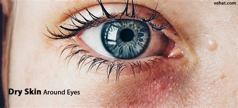 Dry Skin Around Eyes- Causes And Home Remedies