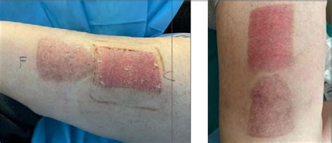 Improvement of Scar Quality in Split-Thickness Skin Graft Donor Sites: a single blind randomized ...