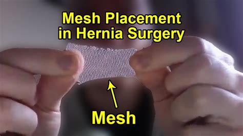 No Mesh Hernia Repair