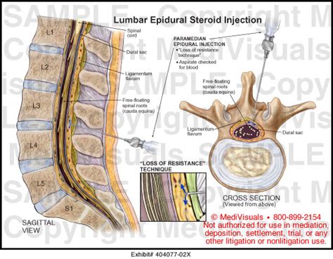 Lumbar Epidural Steroid Injection Medical Illustration