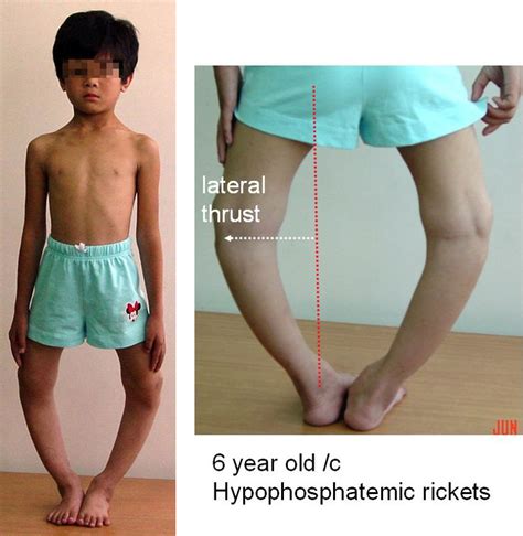 Familial hypophosphatemic rickets in 2020 (With images) | Genu varum, Gym shorts womens, Pediatrics