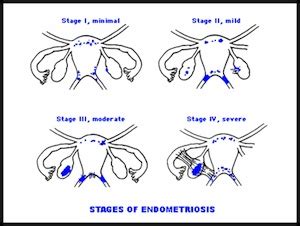 The Four Stages Of Endometriosis. Stage IV, represent. endosucks.wordpress.com | Endometriosis ...