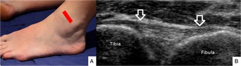 Sonography of the ankle: The lateral ankle and ankle sprains - McKiernan - 2017 - Sonography ...